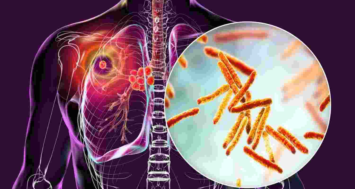 Fight against tuberculosis far from over