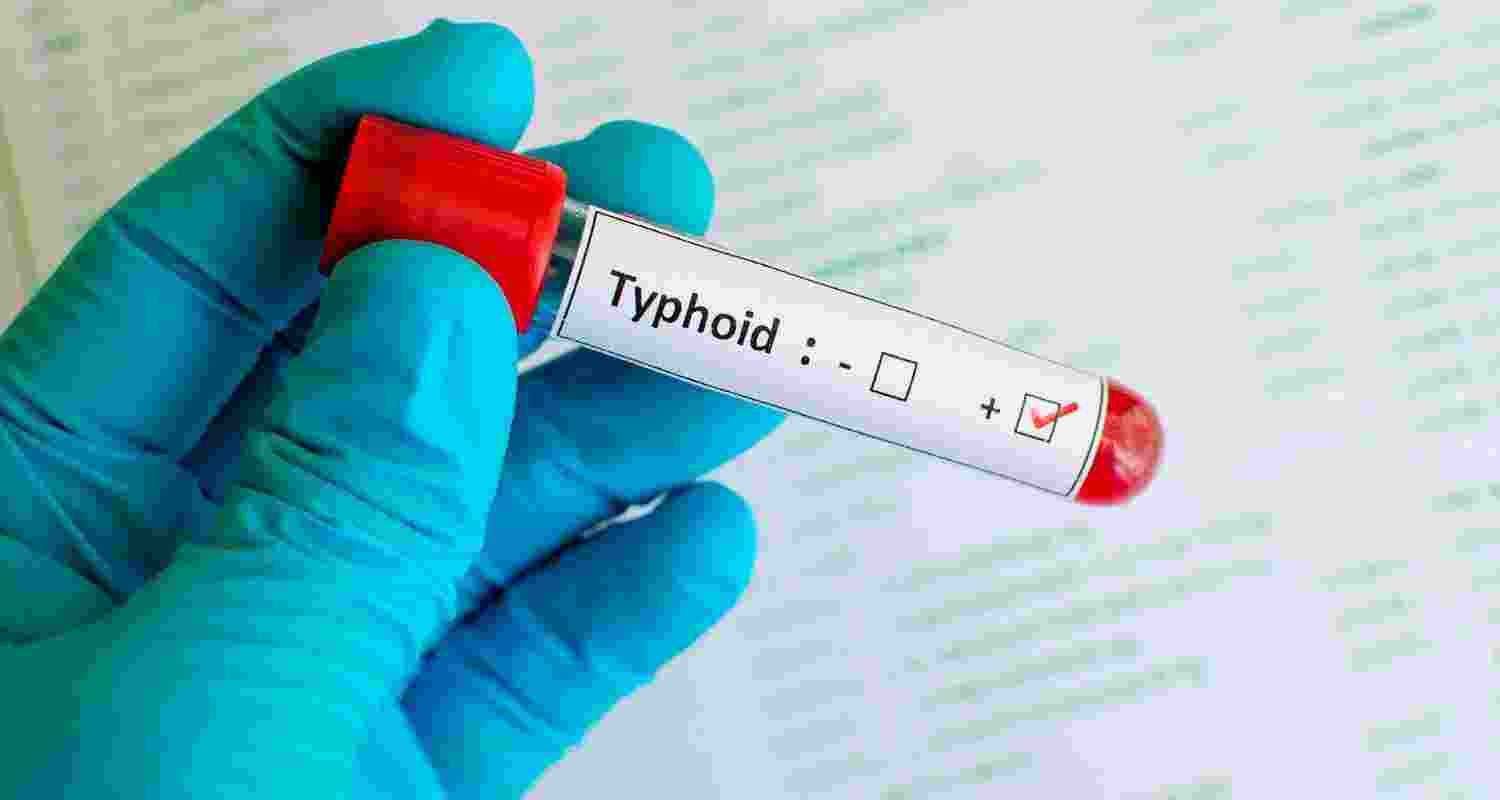 Telangana accounts for India's one in every five Typhoid deaths