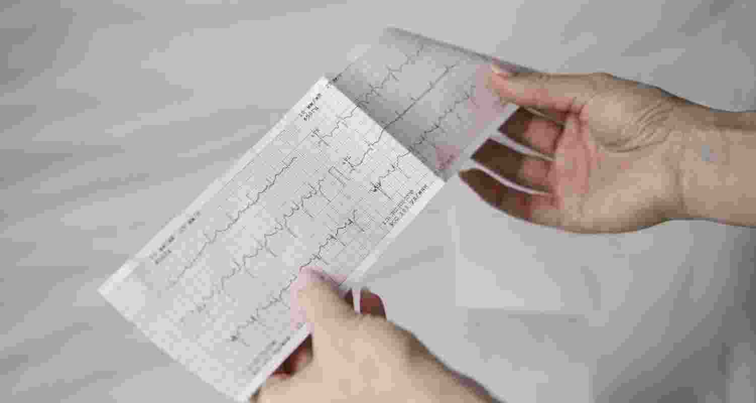 What is sudden adult death syndrome? What is sudden adult death syndrome?