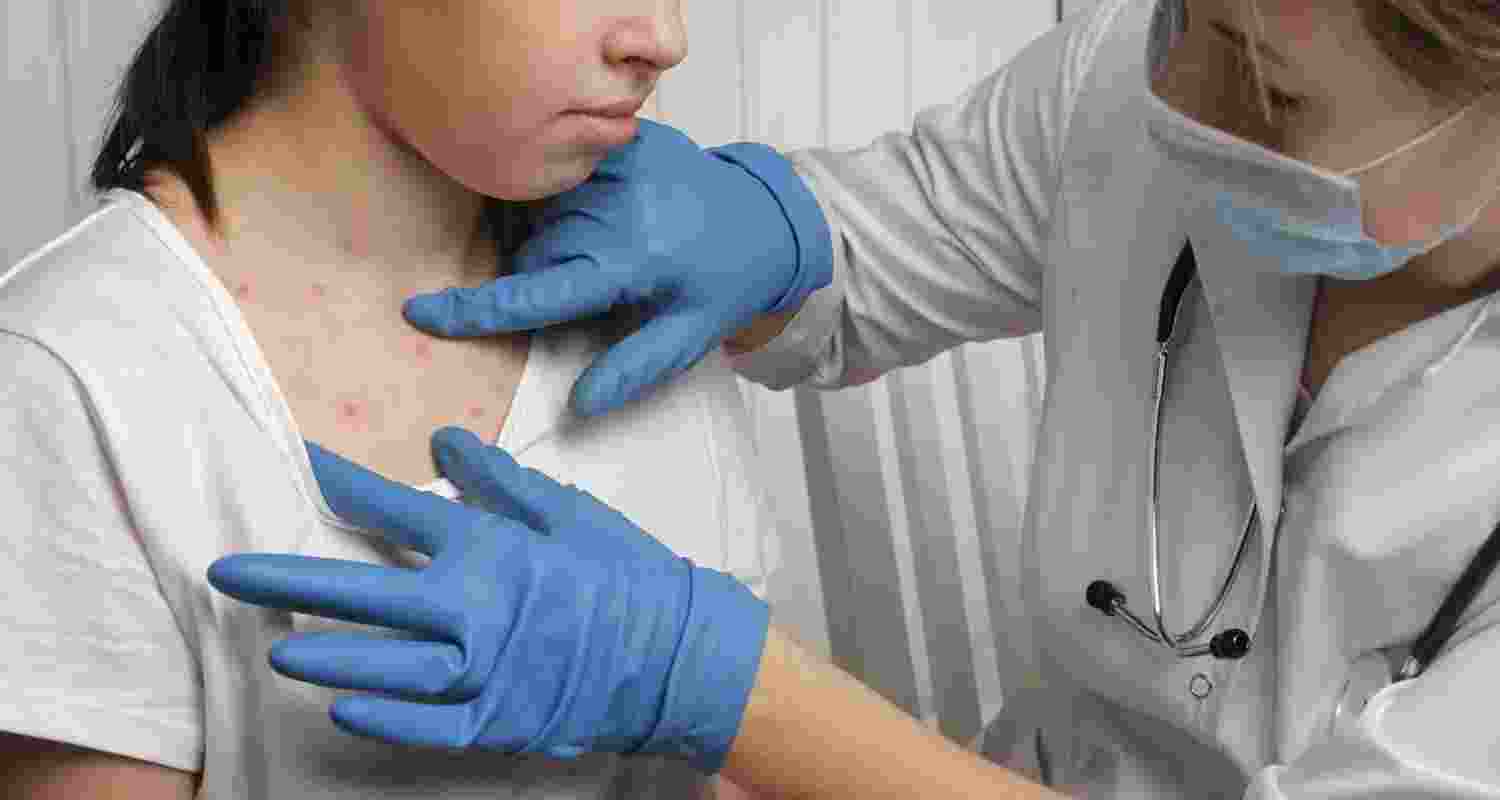 Resurgence of measles a grim sign of next pandemic Resurgence of measles a grim sign of next pandemic