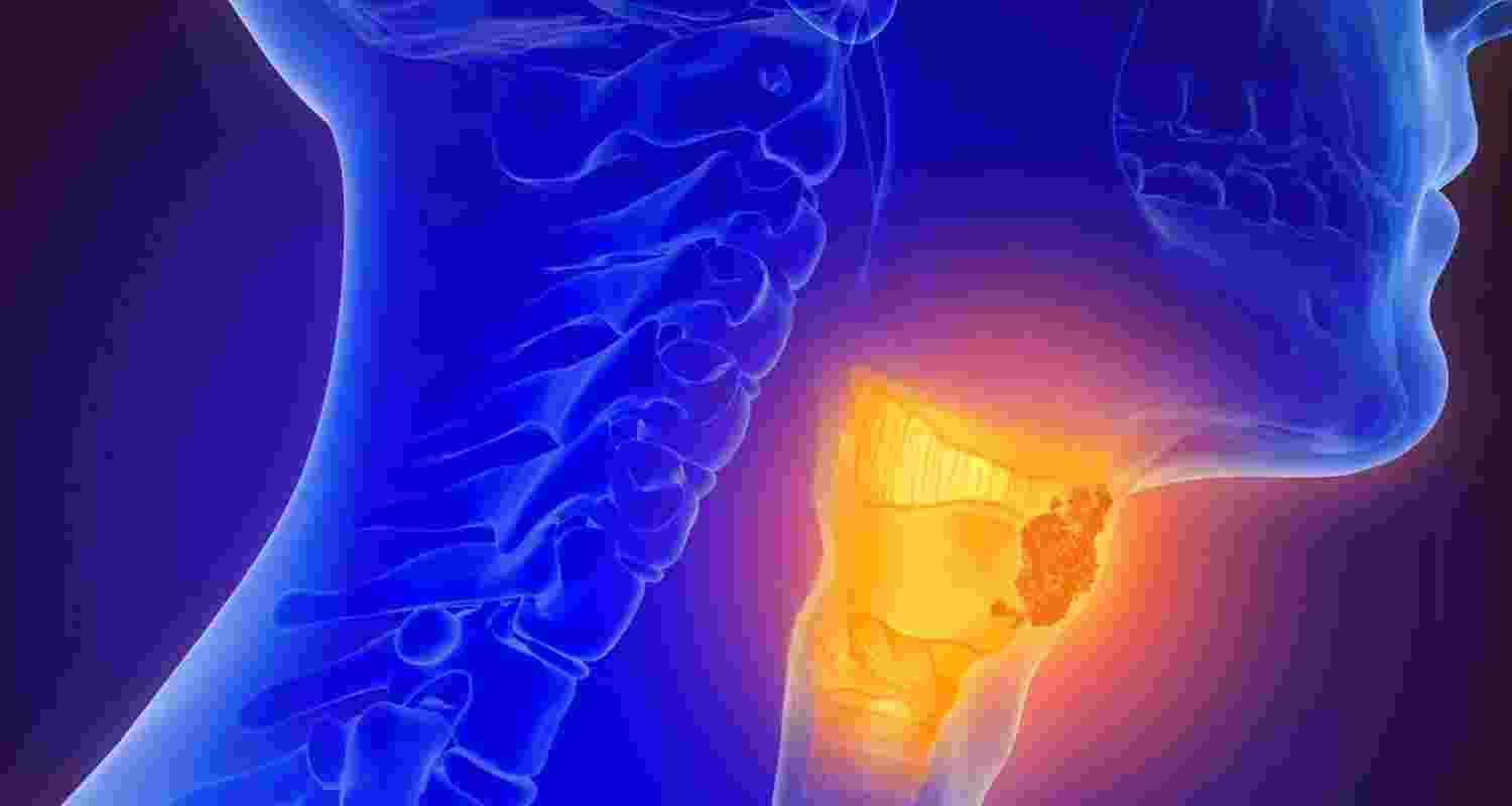 Oral sex now top risk factor for throat cancer rise Oral sex now top risk factor for throat cancer rise