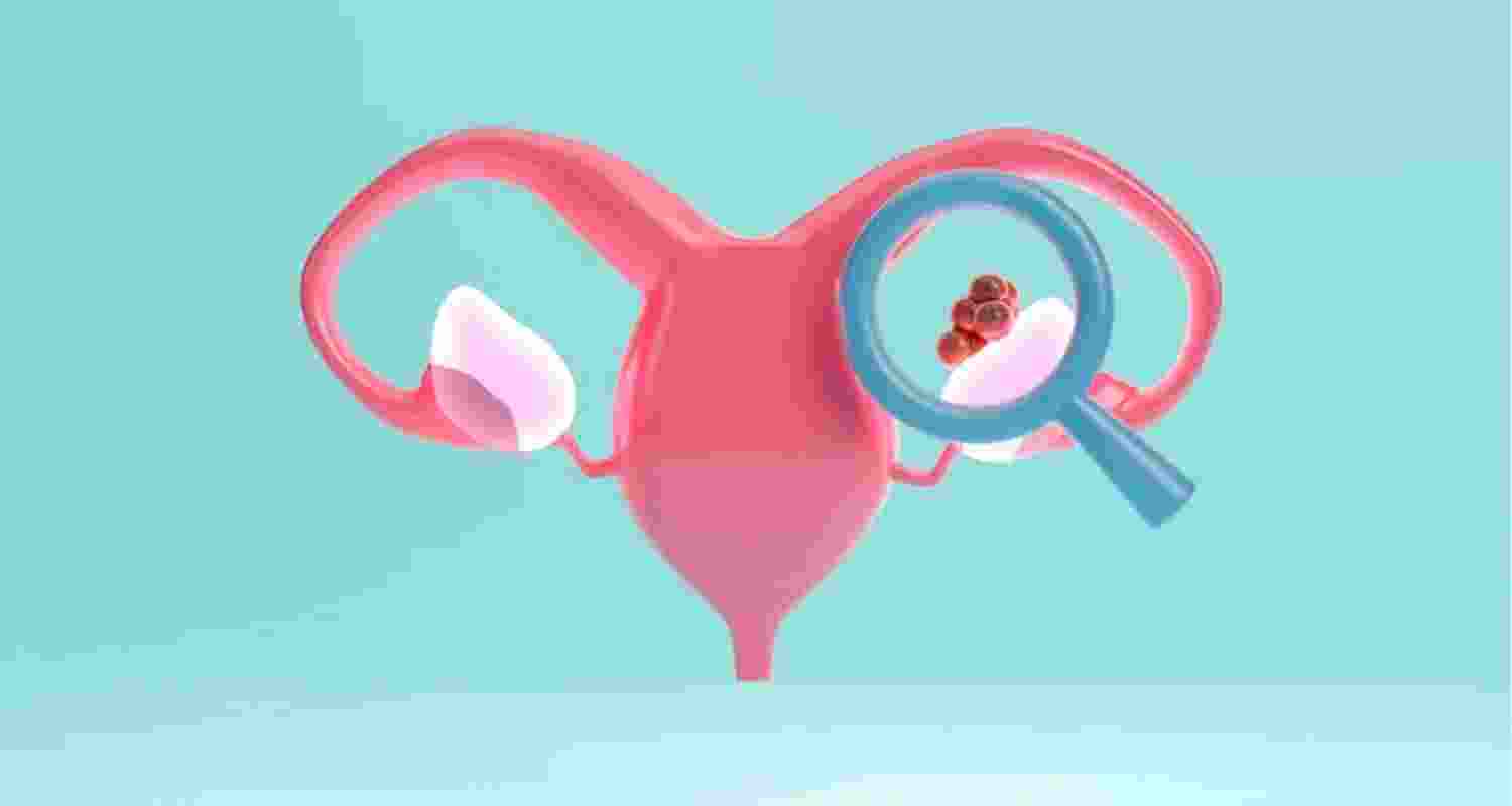 New drug to prolong lives of ovarian cancer patients New drug to prolong lives of ovarian cancer patients